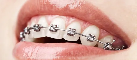 Traditional metal braces correcting crowded and misaligned teeth for a healthier smile.