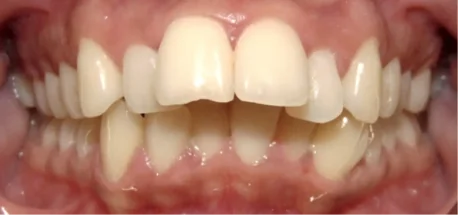 Teeth with orthodontic concerns that can be corrected with braces or clear aligners.