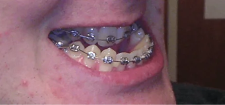 Patient wearing metal braces to straighten teeth and improve bite alignment.