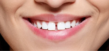 Beautiful smile after orthodontic treatment showing straight, healthy, well-aligned teeth.