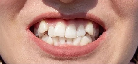 Close-up of crowded teeth before orthodontic correction with braces or aligners.