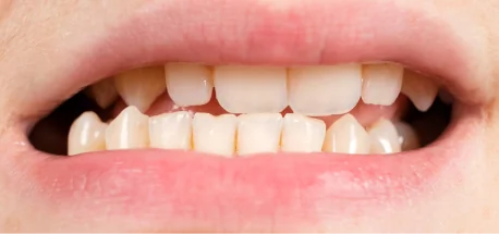 Misaligned teeth before orthodontic treatment to improve smile aesthetics and function