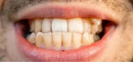 Teeth showing bite and alignment issues suitable for comprehensive orthodontic treatment.