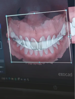 Digital view of a dental model on an Exocad screen, showcasing precision planning for high-quality cosmetic dentistry.