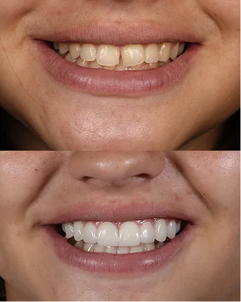 Smile makeover before and after using custom porcelain veneers. This cosmetic dentistry treatment creates a perfectly aligned, bright smile.