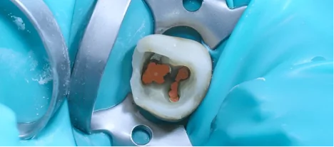 Tooth successfully restored after root canal treatment with a durable dental filling at SmileMakeover Playa del Carmen Dental.