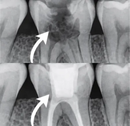 Before and after dental X-rays showing successful infection removal following root canal treatment at SmileMakeover Playa del Carmen Dental.