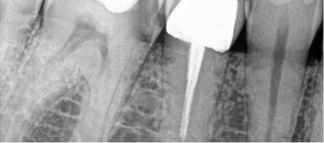Dental X-ray showing an infected tooth before root canal treatment at SmileMakeover Playa del Carmen Dental.