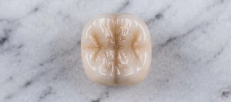 High-quality porcelain dental crown placed after root canal treatment to restore tooth strength and appearance.