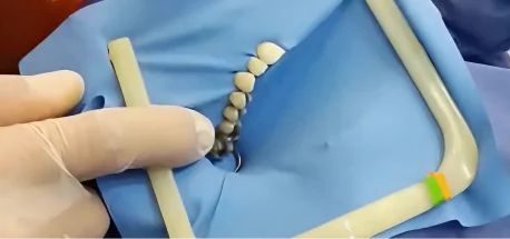 Demonstration of root canal cleaning and shaping with precision endodontic files before sealing the tooth.