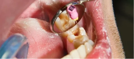Close-up of a root canal procedure showing infected pulp removal using specialized endodontic instruments.