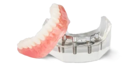 Implant-retained snap-on denture system demonstrating how dentures securely attach to implants.