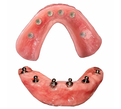 Implant-supported Snap-On Dentures showing the locator attachments that provide a secure and comfortable fit.