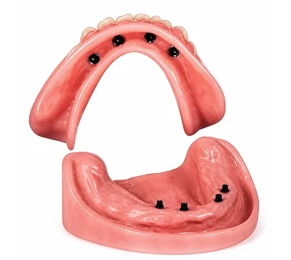 Removable Snap-On Dentures with implant attachment system for improved stability, comfort, and chewing function.