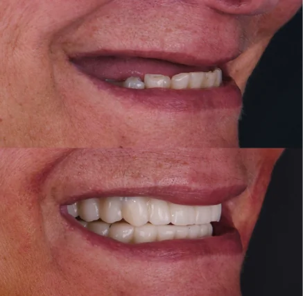 Before and after comparison of a patient restoring missing teeth with natural-looking Snap-On Dentures.