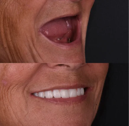 Before and after photos demonstrating improved smile aesthetics after treatment with Snap-On Dentures.