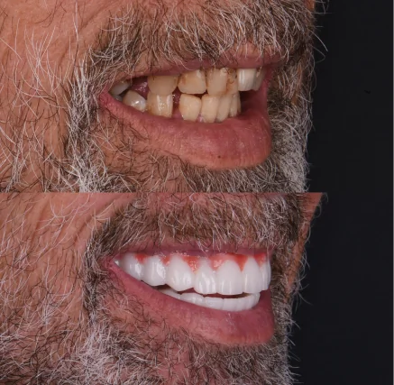 Before and after results showing a dramatic smile transformation with implant-supported Snap-On Dentures.