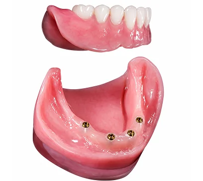 Upper and lower Snap-On Dentures designed to securely attach to dental implants for a stable full-arch restoration.