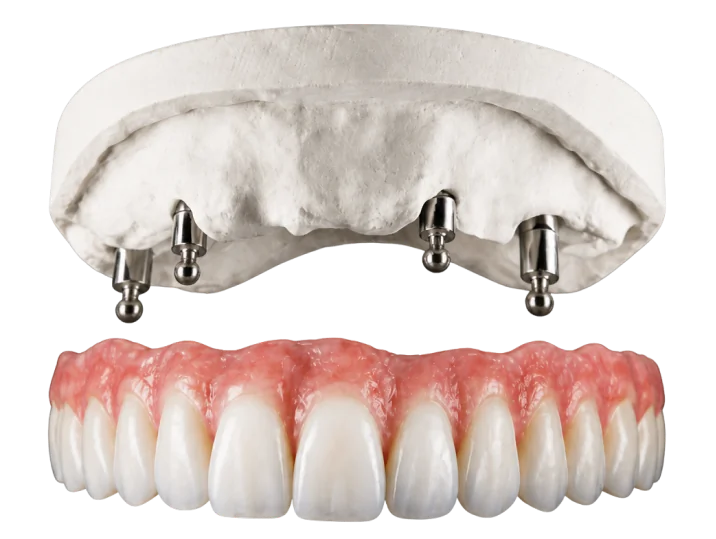 Dental model demonstrating how snap-on dentures work, featuring four implant abutments and a custom full-arch restoration designed for easy maintenance, improved appearance, and better stability while eating.