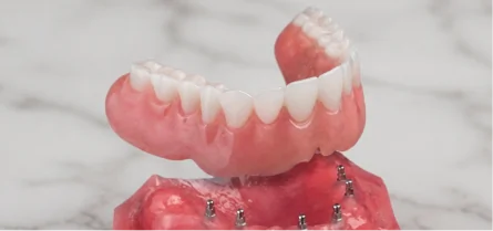 Snap-on denture prosthesis supported by dental implants for a secure and removable smile solution.