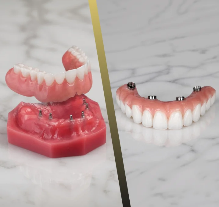 Side-by-side dental model comparison of removable Snap On Dentures and fixed All on 4 Dental Implants, illustrating the difference between removable implant-supported restorations and permanent full-arch solutions.