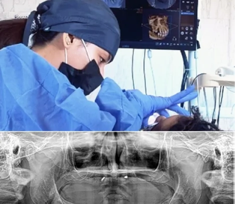 Dental implant surgical procedure being performed by a specialist during implant placement.