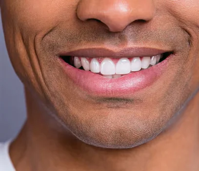Close-up of a man's bright, white smile, showcasing the aesthetic results of a professional teeth whitening treatment.