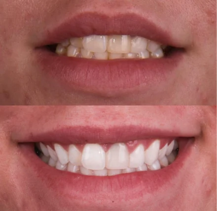 Before and after comparison of a patient's smile, showing the successful transformation and brightening achieved with a professional teeth whitening treatment.