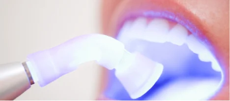 Close-up of a patient undergoing laser teeth whitening treatment with a blue light-activation device positioned for optimal results.