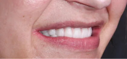 Close-up of a person's smile showcasing the immediate aesthetic results of composite resin veneers.
