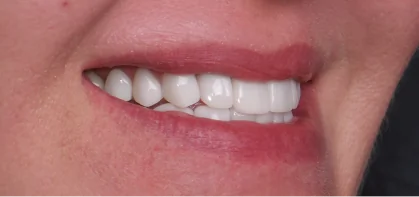 Close-up of a bright, natural-looking smile enhanced with Emax lithium disilicate porcelain veneers.