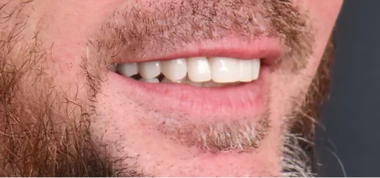 Detail view of a smile restored with durable zirconia dental veneers, highlighting strength and aesthetics.