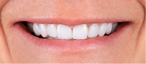 Close-up of natural-looking porcelain veneers creating a bright, symmetrical smile.