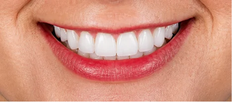 Female patient showing beautifully crafted porcelain veneers with a natural appearance.