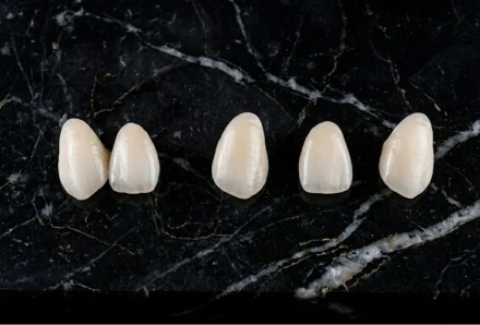 Macro shot of five custom dental veneers lined up on a polished black marble surface, showcasing their translucent, layered ceramic structure and polished finish