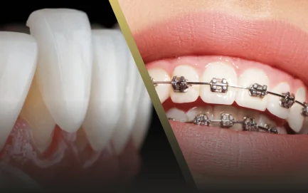 Side-by-side comparison of porcelain veneers and orthodontic braces for smile correction.