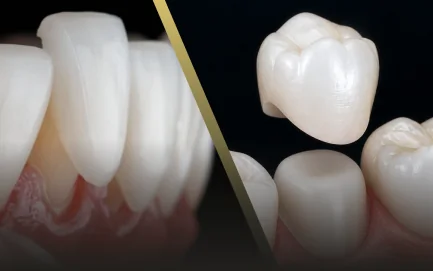 Visual comparison explaining the differences between porcelain veneers and dental crowns.