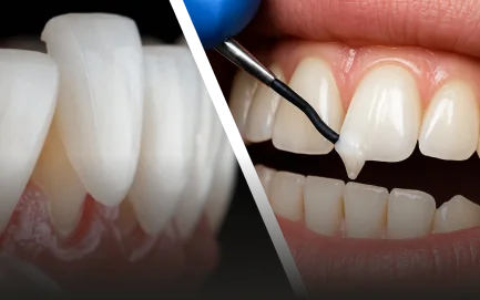 Illustration comparing gum contouring and porcelain veneers for achieving a balanced smile