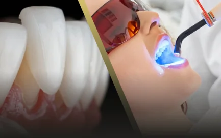 Comparison of professional teeth whitening and porcelain veneers for cosmetic smile improvement