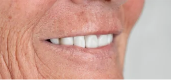 smile results after 